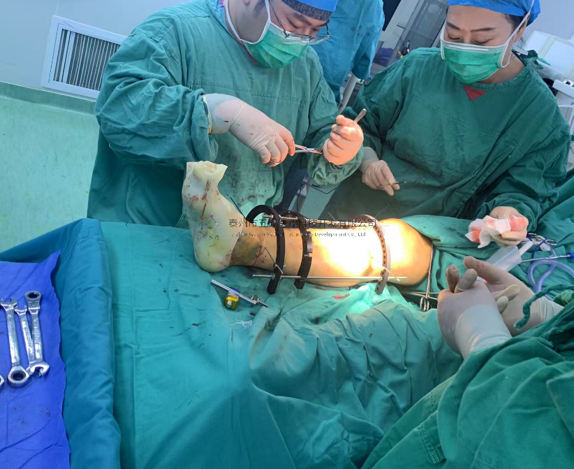【望京醫院】不開刀治骨折病例分享——脛骨遠端骨折腓骨骨折